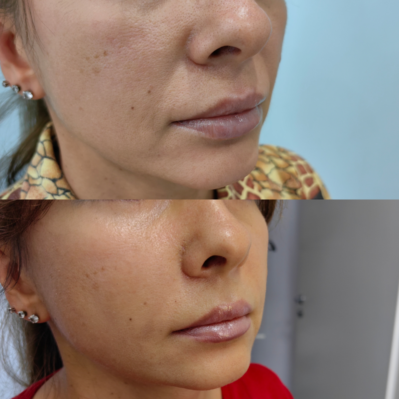 Липофилинг носогубных складок