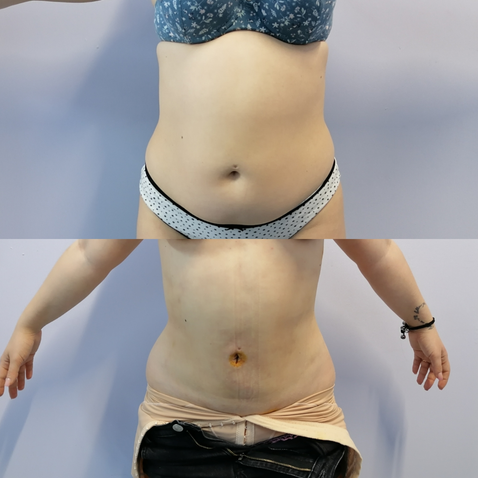 Ультразвуковая липосакция Vaser