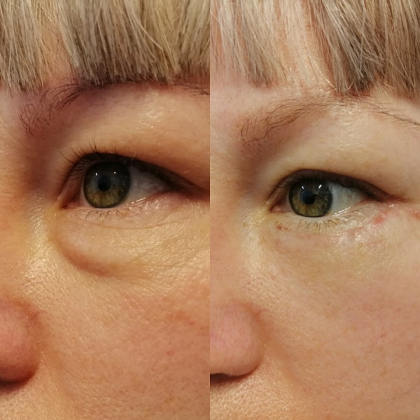 Нижняя блефаропластика (2недели после операции)