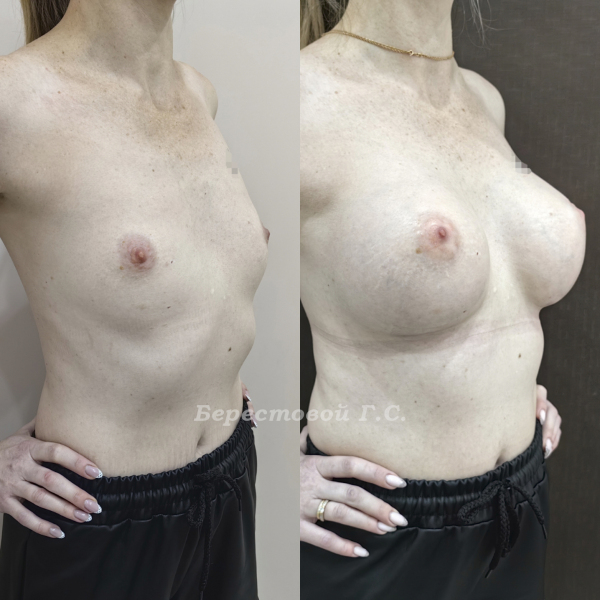 Увеличение груди круглыми имплантами