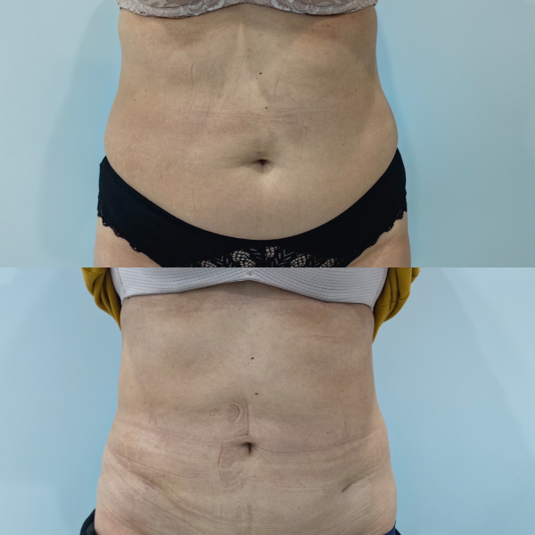 Ультразвуковая липосакция Vaser