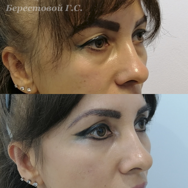 Круговая блефаропластика (3 месяца после операции)