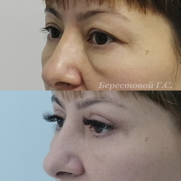 Верхняя блефаропластика (3 месяца после операции)