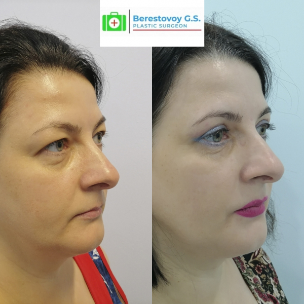 Верхняя блефаропластика (3 месяца после операции)
