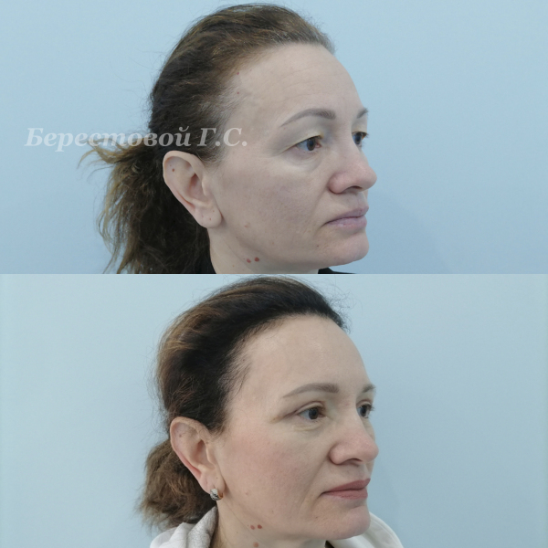 Верхняя блефаропластика (3 месяца после операции)