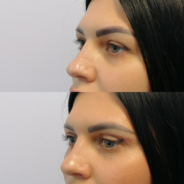 Верхняя блефаропластика (месяц после операции)