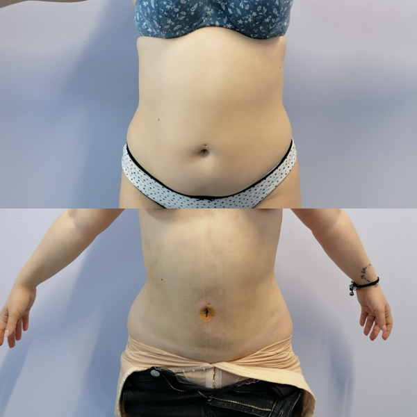 Ультразвуковая липосакция Vaser