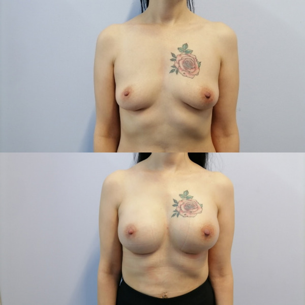 Увеличение груди круглыми имплантами