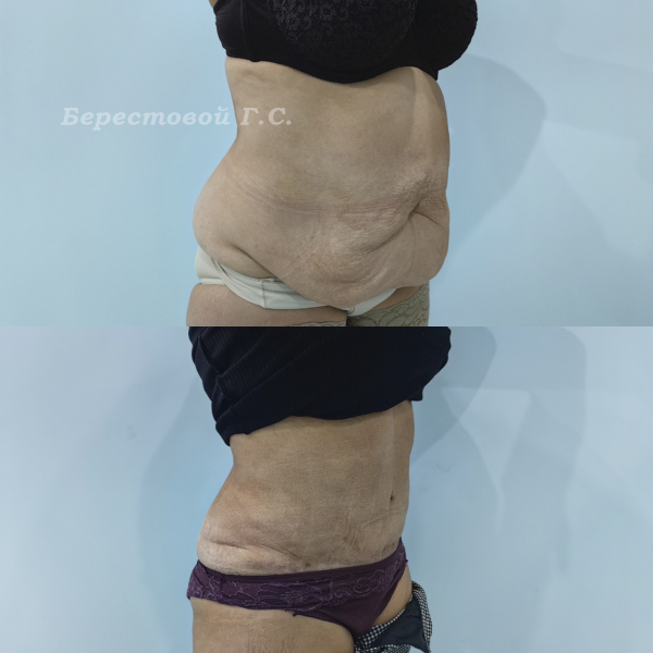 Абдоминопластика