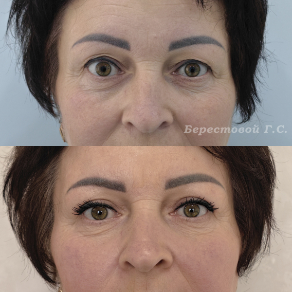 Верхняя блефаропластика (3 месяца после операции)