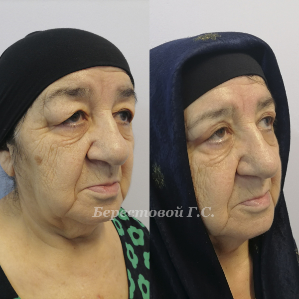 Верхняя блефаропластика (месяц после операции)