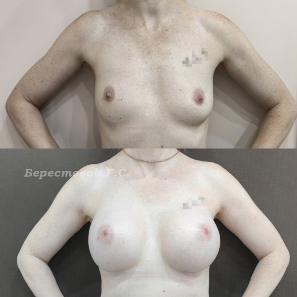 Увеличение груди круглыми имплантами