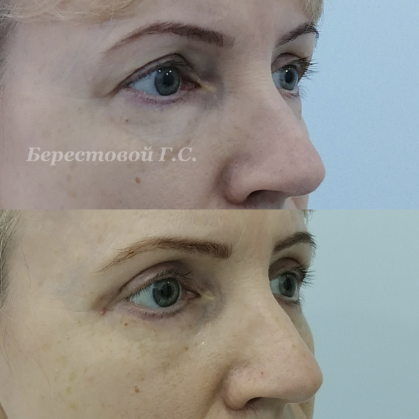 Верхняя блефаропластика (месяц после операции)