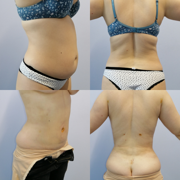 Ультразвуковая липосакция Vaser