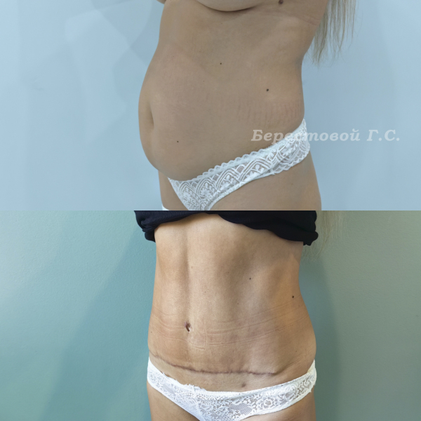 Абдоминопластика + Vaser липосакция
