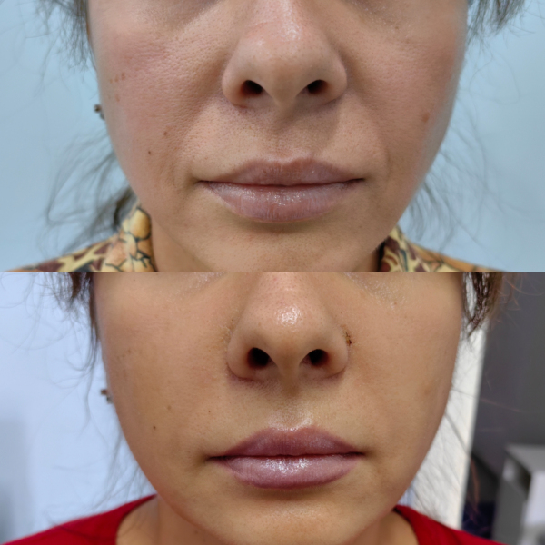 Липофилинг носогубных складок