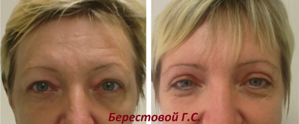 Верхняя блефаропластика