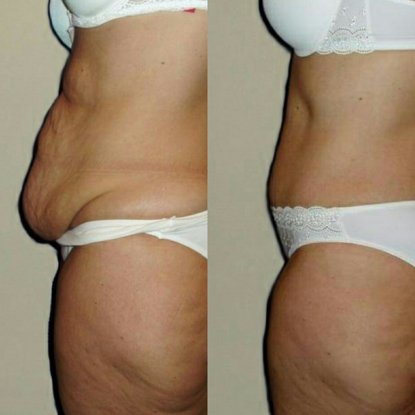 Абдоминопластика