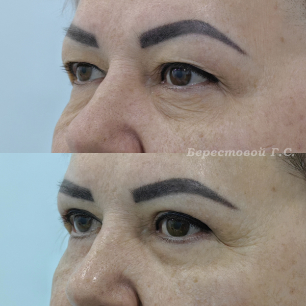 Круговая блефаропластика (3 месяца после операции)