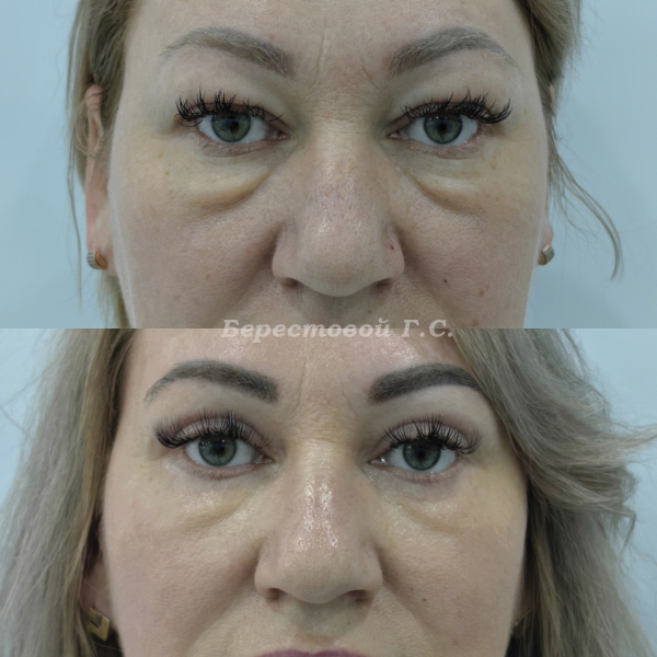 Круговая блефаропластика (3 месяца после операции)