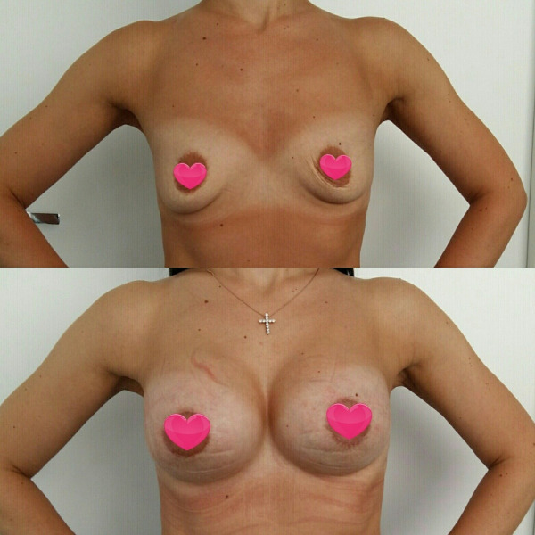 Увеличение груди круглыми имплантами + подтяжка