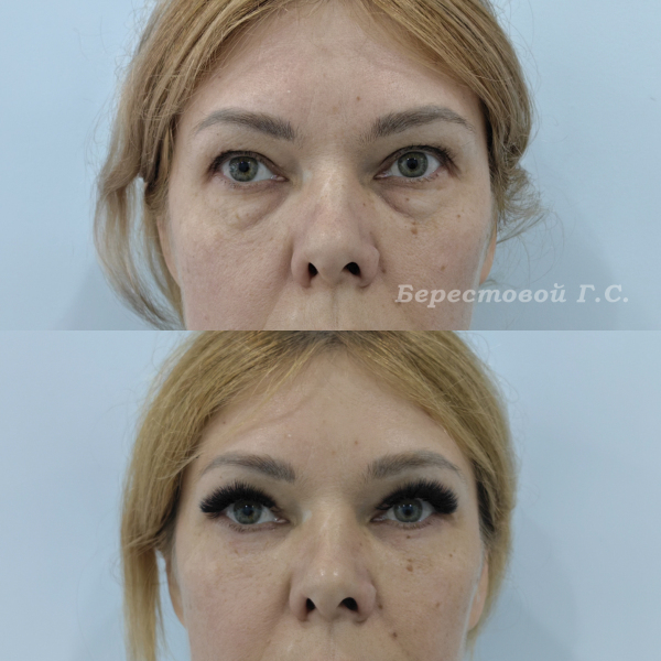 Нижняя блефаропластика (3 месяца после операции)