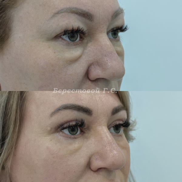 Круговая блефаропластика (3 месяца после операции)