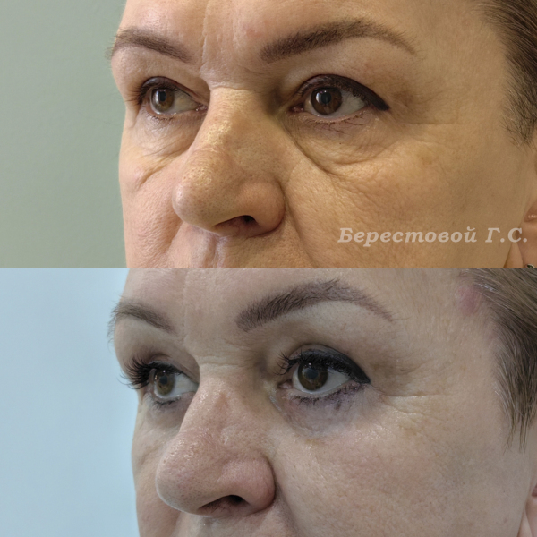 Нижняя блефаропластика (3 месяца после операции)