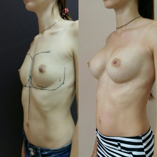 Увеличение груди анатомическими имплантами