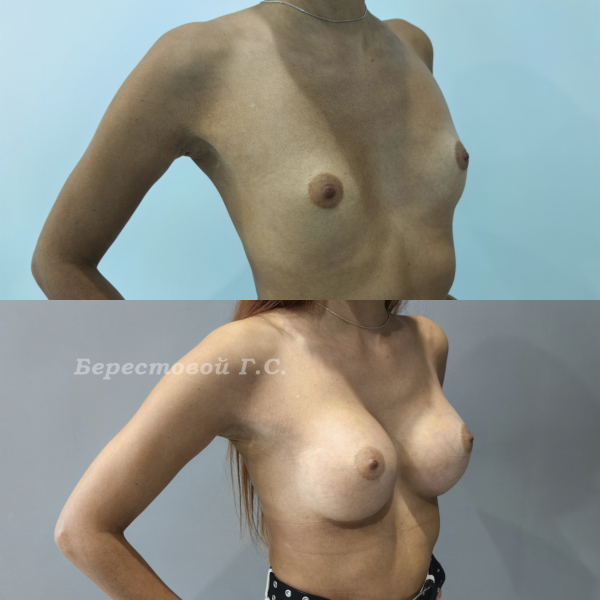 Увеличение груди круглыми имплантами