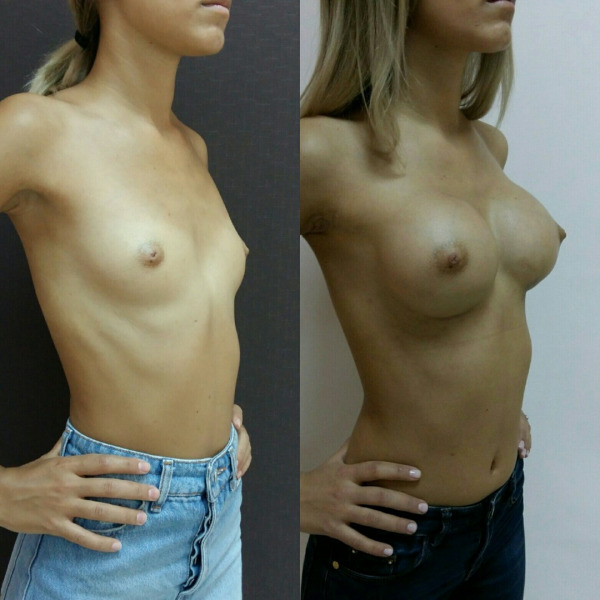 Увеличение груди круглыми имплантами