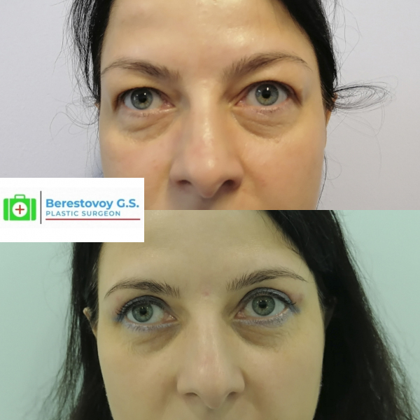 Верхняя блефаропластика (3 месяца после операции)