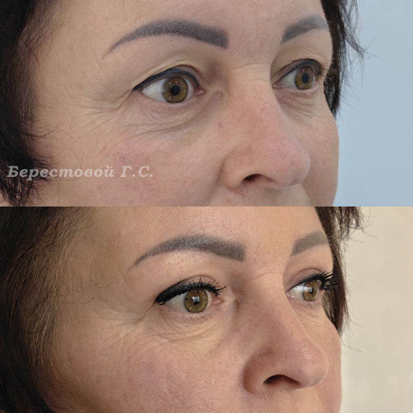 Верхняя блефаропластика (3 месяца после операции)