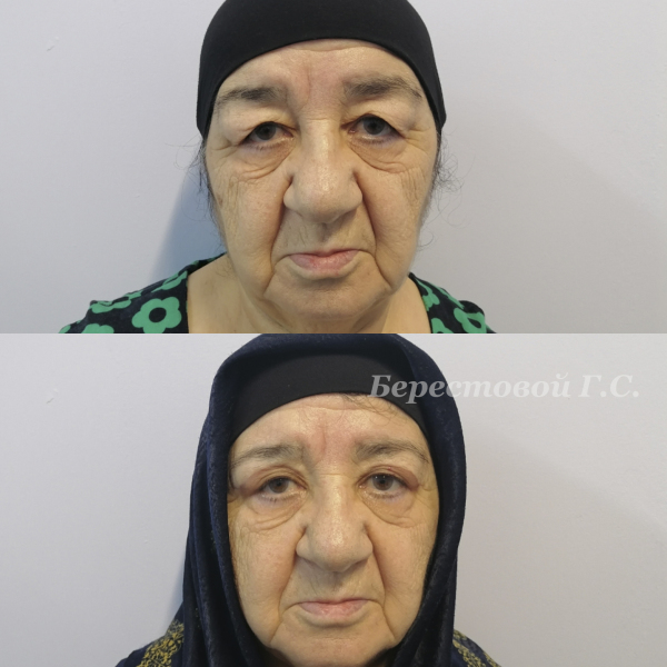 Верхняя блефаропластика (месяц после операции)