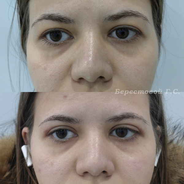 Верхняя блефаропластика (3 месяца после операции)