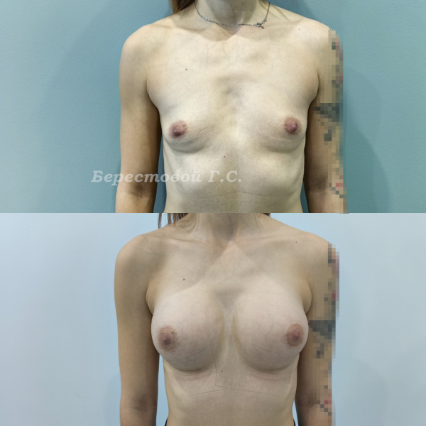 Увеличение груди круглыми имплантами