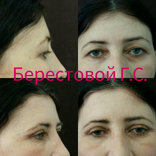 Верхняя блефаропластика