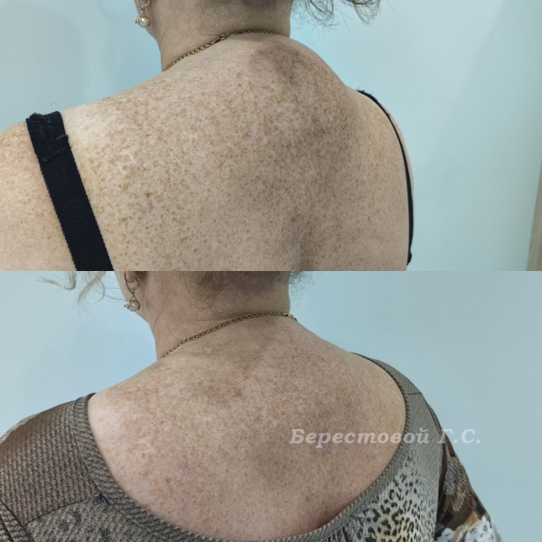 Липосакция "шейного горба"