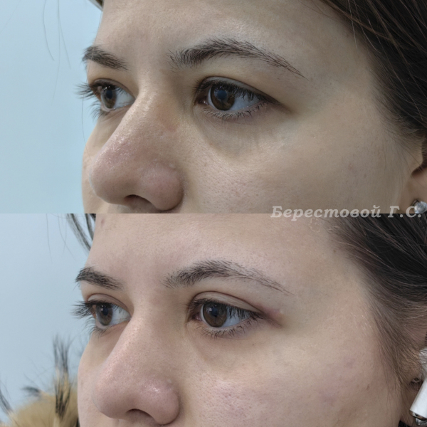 Верхняя блефаропластика (3 месяца после операции)