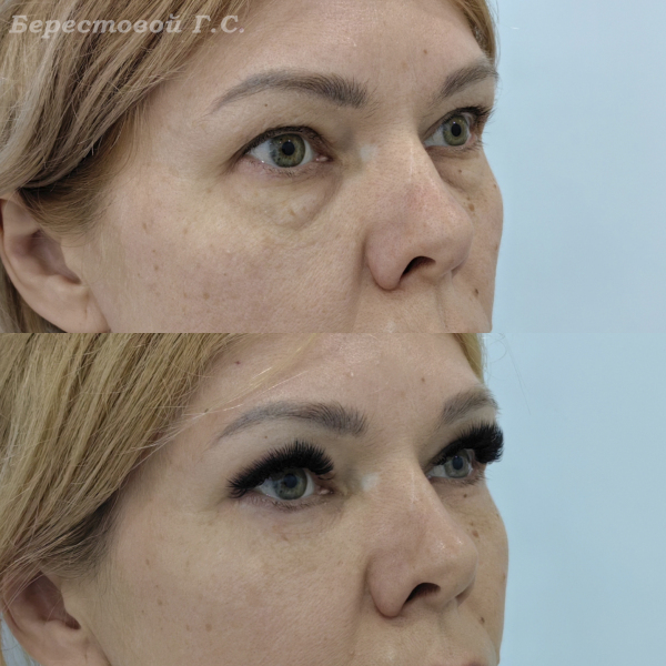 Нижняя блефаропластика (3 месяца после операции)