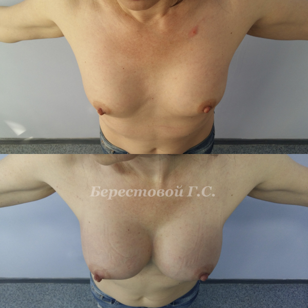 Увеличение груди круглыми имплантами