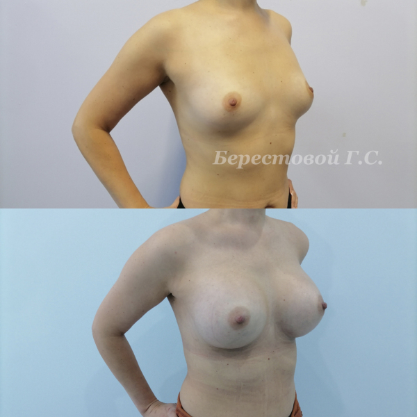 Увеличение груди круглыми имплантами