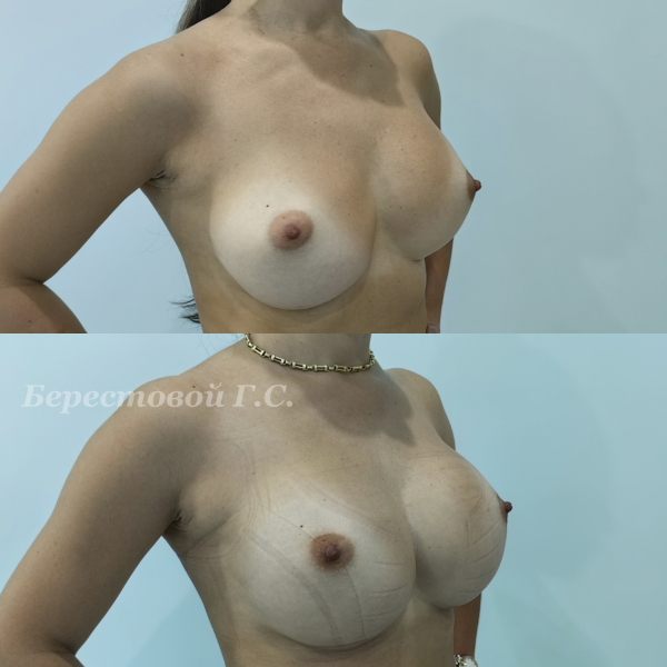 Увеличение груди круглыми имплантами