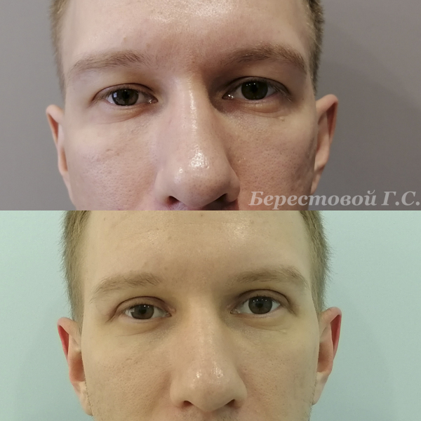 Верхняя блефаропластика (3 месяца после операции)