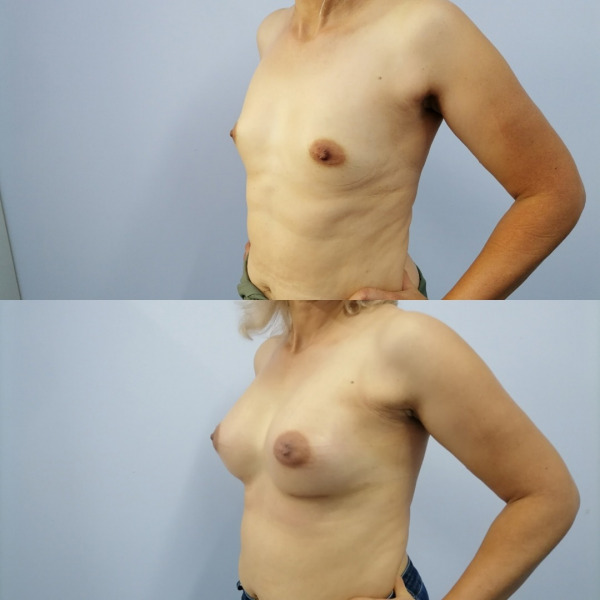 Увеличение груди круглыми имплантами