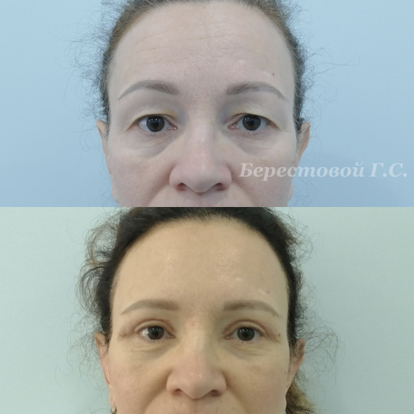Верхняя блефаропластика (3 месяца после операции)