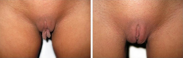 Уменьшение половых губ Ставрополь