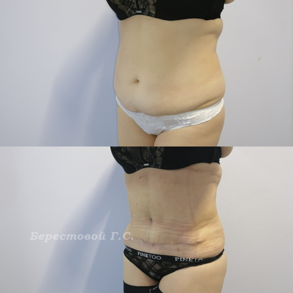 Абдоминопластика