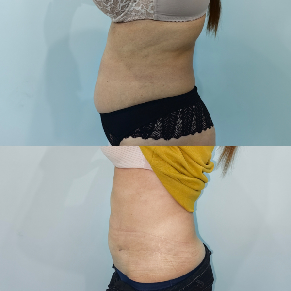 Ультразвуковая липосакция Vaser