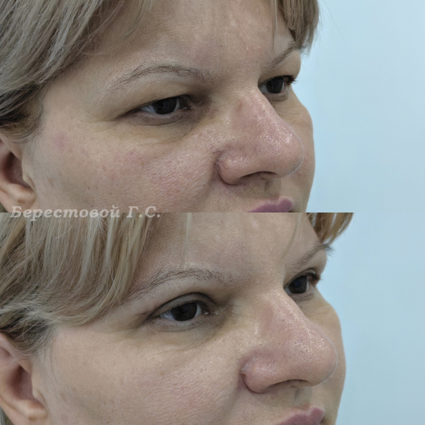 Верхняя блефаропластика (3 месяца после операции)